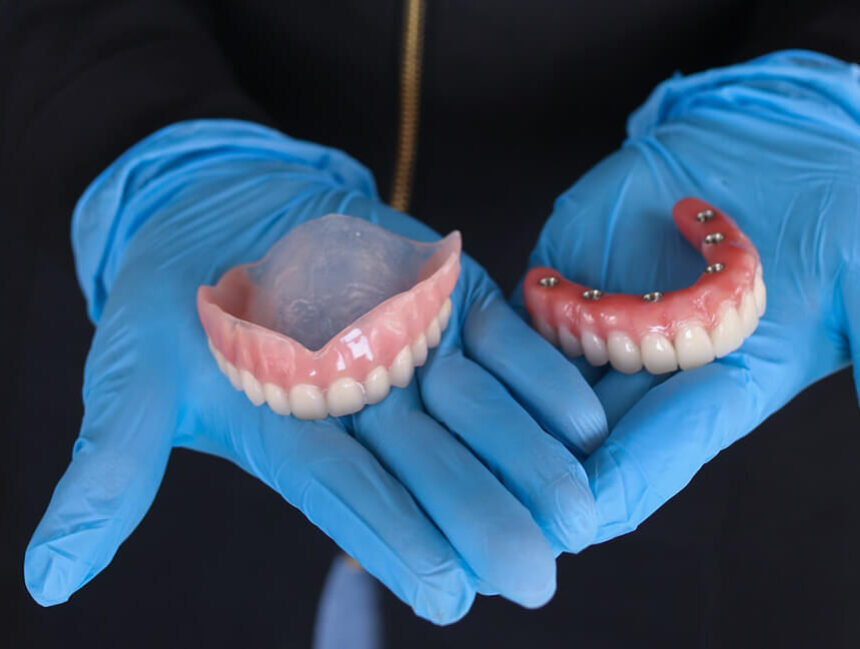 Implant Retained Dentures