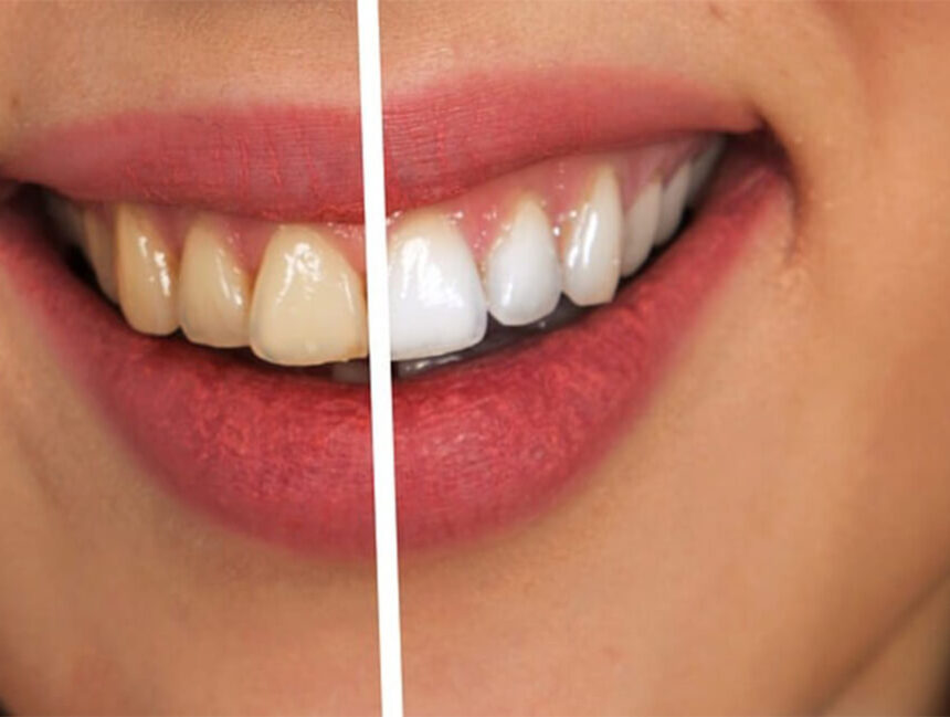 Teeth Whitening